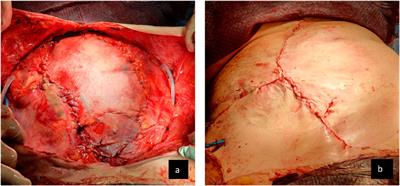 Case Report: Tissue Expanders—Another Tool in the Armamentarium for the Treatment of Complex Ventral Hernia